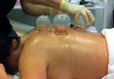 Cupping Therapy For A Month? It’s Dangerous!