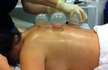 Cupping Therapy For A Month? It’s Dangerous!