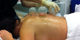 fire-cupping-1211191_960_720